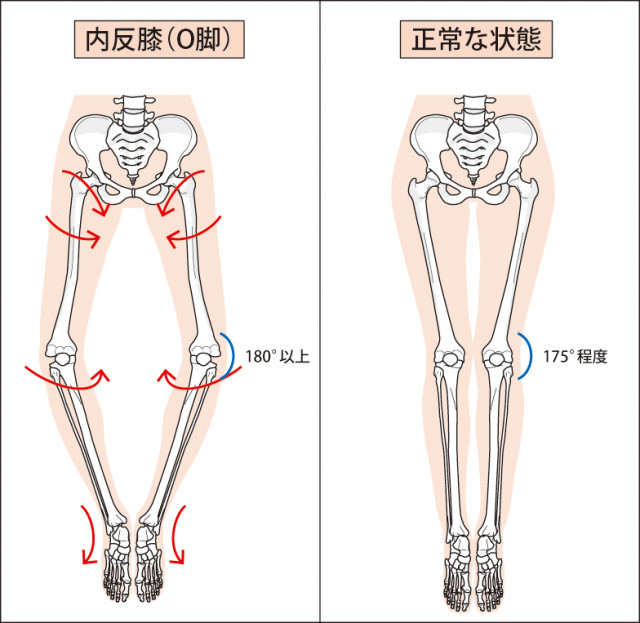 O脚 X脚 新潟の整体 医師も推薦 藤見名倉堂鍼灸整骨院